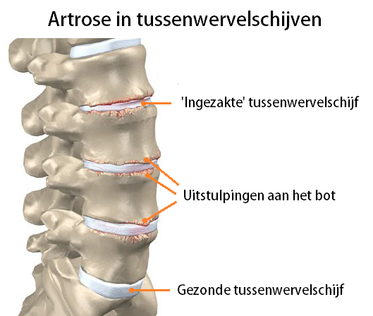 schade schokkend Aubergine Artrose Rug | Symptomen, Behandeling en Oefeningen