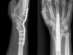 Röntgenfoto van een polsarthrodese
