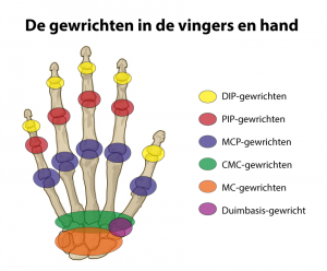 De MCP-gewrichten van de vingers zijn paars omcirkeld. Afkortingen: DIP = Distaal InterPhalangeaal (topje van de vinger), PIP = Proximaal InterPhalangeaal (halverwege de vinger), MCP = MetaCarpoPhalangeaal (basis van de vingers), CMC = CarpoMetaCarpaal (middenhand), MC = MidCarpaal (handwortel)