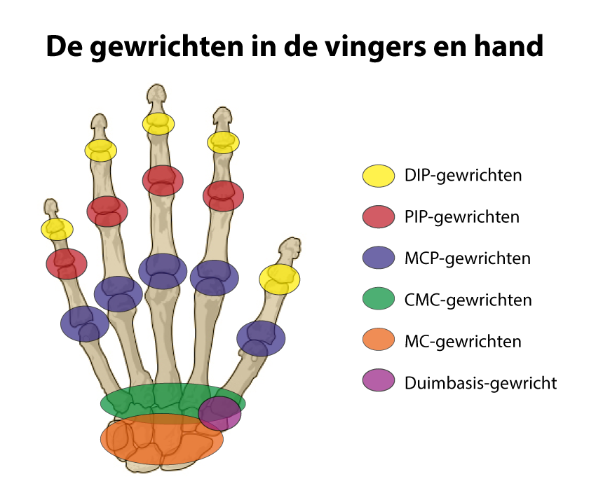 De PIP-gewrichten van de vingers zijn rood omcirkeld. De duim heeft geen PIP-gewricht. Afkortingen: DIP = Distaal InterPhalangeaal (vingertoppen), MCP = MetaCarpoPhalangeaal (basis van de vingers), CMC = CarpoMetaCarpaal (middenhand), MC = MidCarpaal (handwortel)