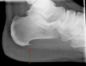 Hielspoor is op een röntgenfoto gemakkelijk te herkennen