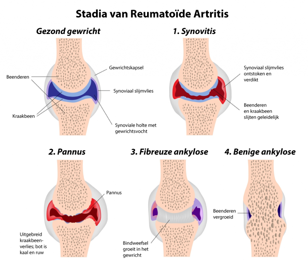 ReumatoÃ¯de artritis begint met een ontsteking van het slijmvlies. Geleidelijk treden er steeds meer veranderingen in het gewricht op, die niet meer omgekeerd kunnen worden. Tijdig de ontsteking bestrijden is dus van belang!