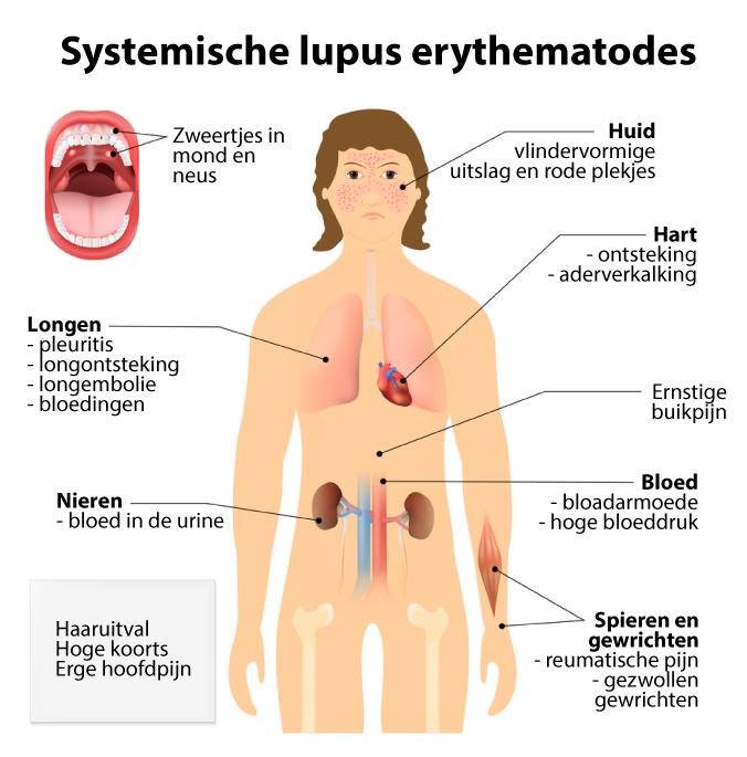 Taiko buik pariteit Slijm Lupus erythematodes | Diagnose, Betekenis, Symptomen, Erfelijk
