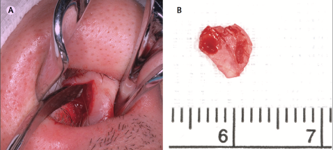 Bij A is het neus-tussenschot zichtbaar, dat gedeeltelijk gebruikt werd voor de transplantatie. Bij B is het stukje neus-kraakbeen te zien dat eruit gehaald is. Let ook op de afmetingen in millimeters. (Deze afbeelding is rechtstreeks afkomstig uit de publicatie. Zie bron beneden.)