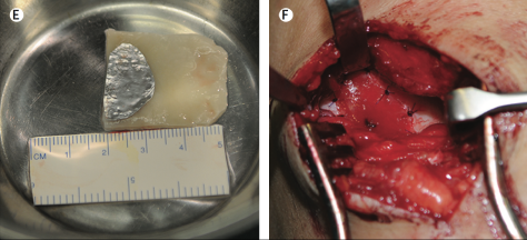 Bij E is te zien hoe ver het neus-kraakbeen is uitgegroeid. Let ook hier weer op de afmetingen in millimeters. Bij F is te zien dat een stukje hiervan in de knie is geplaatst: de hechtdraden zijn duidelijk zichtbaar op de foto.(Deze afbeelding is rechtstreeks afkomstig uit de publicatie. Zie bron beneden.)