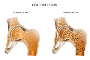 voedingsstoffen osteoporose schematisch