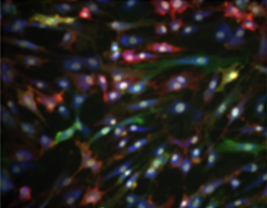 Dit is een afbeelding uit het onderzoek. Cellen met CD248 lichten groen op, cellen met PDPN zijn rood gekleurd. Gele cellen bevatten beiden. (Dit zijn niet de echte kleuren; door middel van fluorescentiemicroscopie is dit zichtbaar gemaakt ten behoeve van het onderzoek.)