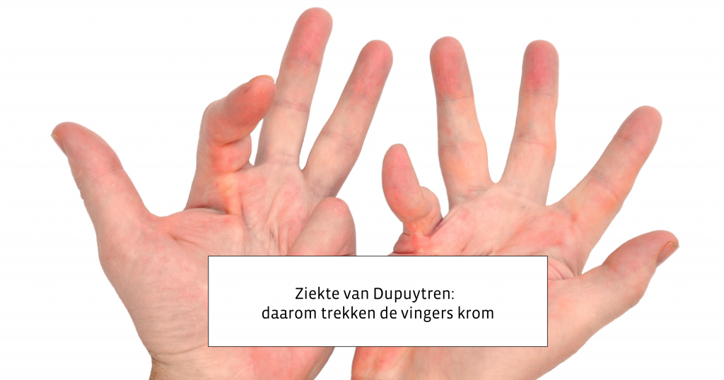 Ziekte van Dupuytren. Oorzaak Symptomen Diagnose en Behandeling Ziekte van Dupuytren. Oorzaak Symptomen Diagnose en Behandeling