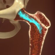 Stamceltherapie bij botontkalking stapje dichterbij