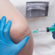 Italiaanse artsen verfijnen hyaluron-injecties bij knie-artrose